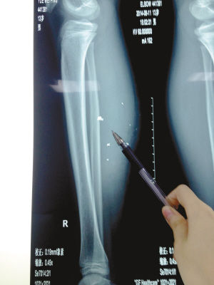 X光片顯示：手機(jī)電池內(nèi)的物質(zhì)被炸進(jìn)了小平的右小腿里
