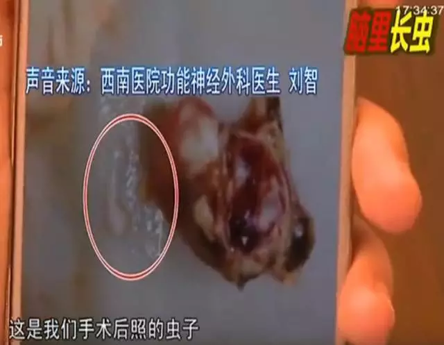 少女大腦皮層萎縮 醫(yī)生從她腦子里捉出5厘米蟲子