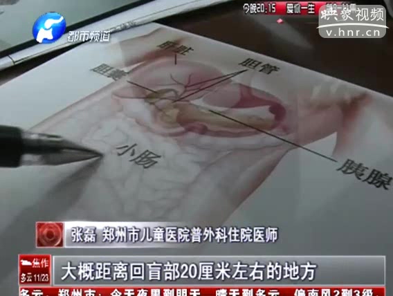 女童吃入棒棒糖棍 腸子被戳穿